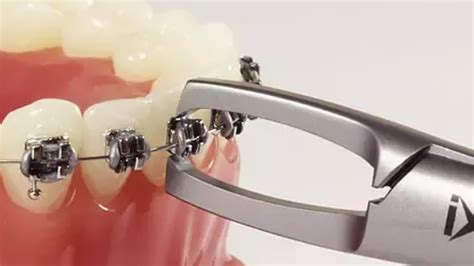 how to remove ortho brackets